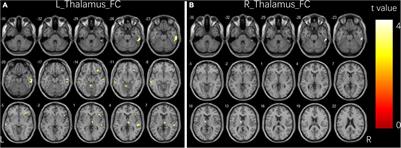 Reconfiguration of static and dynamic thalamo-cortical network functional connectivity of epileptic children with generalized tonic-clonic seizures